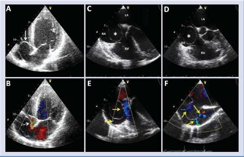 Figure 1 From Huge Interatrial Septal Aneurysm With Fenestrated Atrial