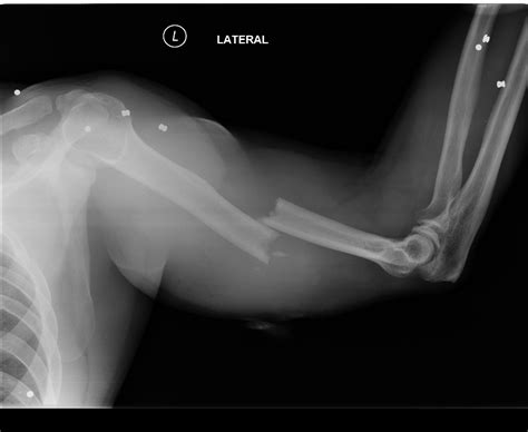 Humeral Shaft Fractures Trauma Orthobullets