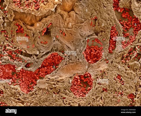 Ulcerative Colitis Coloured Scanning Electron Micrograph Sem Of