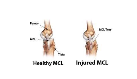 Mcl - Mcl Tear Physiotherapy Treatment Metro Physio ...