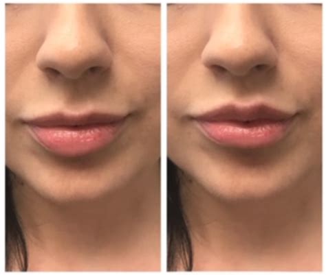 Juvederm El Segundo Ca La Skincare Center