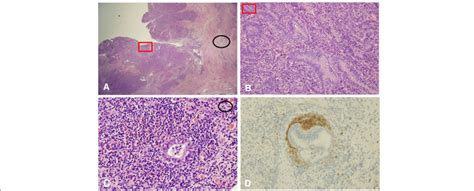 A Dilated Fallopian Tubes Revealed Marked Mucosal Hyperplasia Under Low