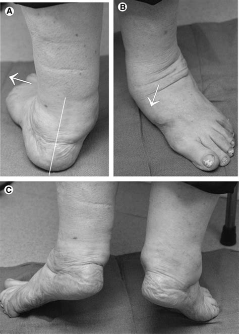 Posterior Tibial Tendon Dysfunction Pttd Riverside Podiatry