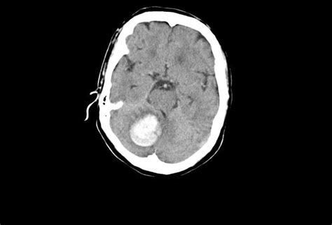 Abnormal Head Ct Scan