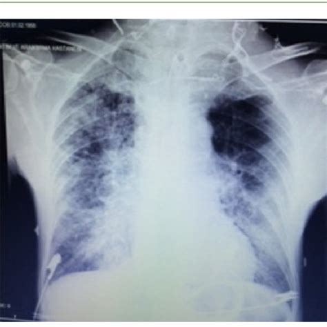 Bilateral Parenchymal Infiltrates In Lung X Ray Download Scientific