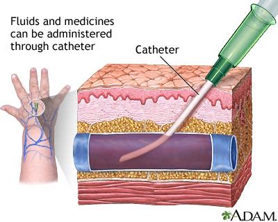 alkes  catheter