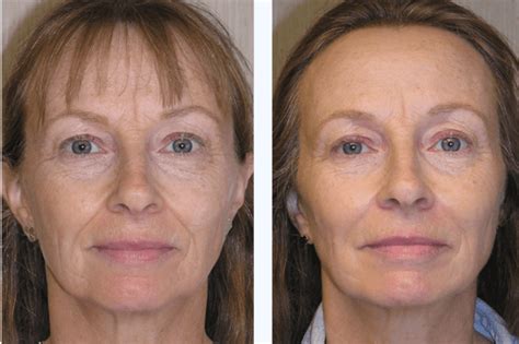 Facial Anti-Aging - Dr. Theodore Belfor, DDS