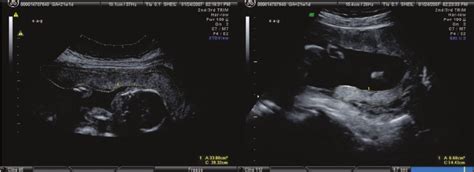 Ultrasound Estimation Of The Relative Amount Of Placenta In The Download Scientific Diagram