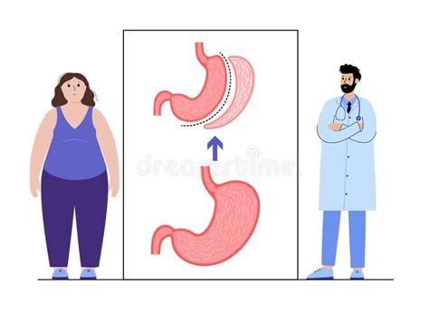 Laparoscopic Sleeve Gastrectomy Stock Vector Illustration Of