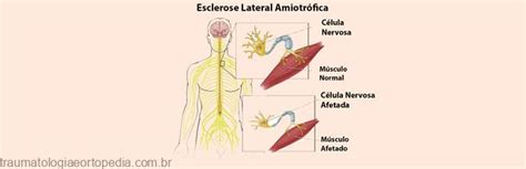 Esclerose Lateral Amiotrófica Traumatologia E Ortopedia