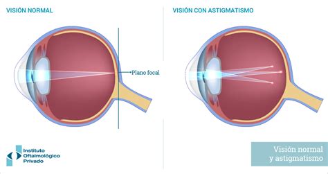 Astigmatismo Enfermedades IOP Instituto Oftalmológico Privado