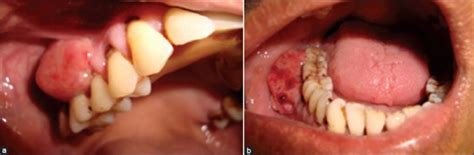 Lesions In A Maxilla And B Mandible Download Scientific Diagram