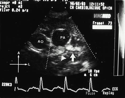 Noninvasive Diagnosis Of Anomalous Origin Of The Left Main Coronary