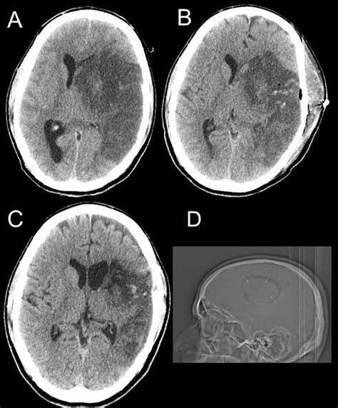 A 36-year-old male with malignant L MCA stroke. a Preoperative axial CT ...