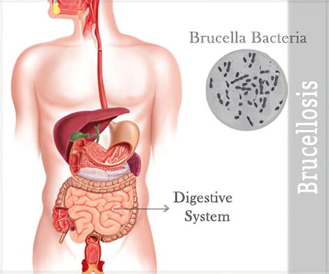 What Is Brucellosis Symptoms Causes Diagnosis Treatment And Prevention Ruudd Lifestyle Blog