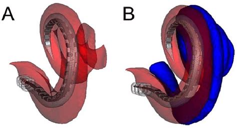 Reconstructed CT images showing a cochlear implant completely within ...