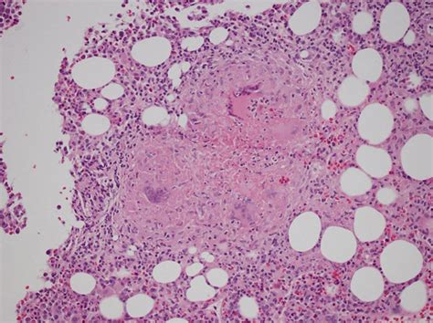 The Bone Marrow Biopsy Showing A Hypercellular Marrow For Age With