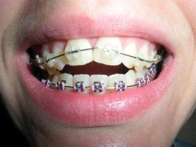 Is It Normal for Spaces to Be Created by Braces? Dentist Answers, Tips
