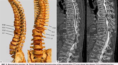 Figure 2 From Compressive Myelopathy From Diffuse Spinal Dural