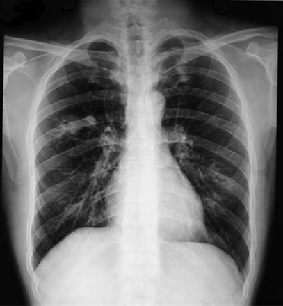 Chest X Ray Infiltrates