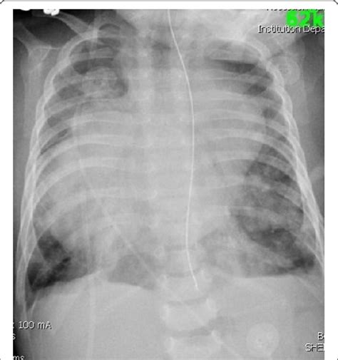 Cardiomegaly Diagram