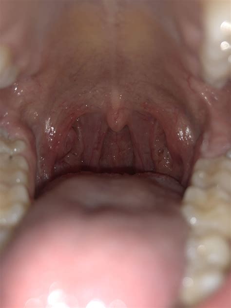 Does This Just Look Like Tonsil Stones More In Comments R Diagnoseme