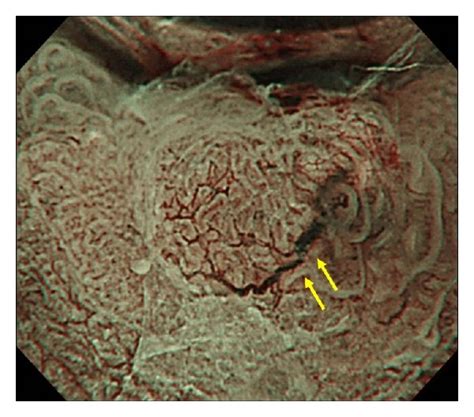 Magnifying Endoscopy With Narrow Band Imaging ME NBI Image Showing A