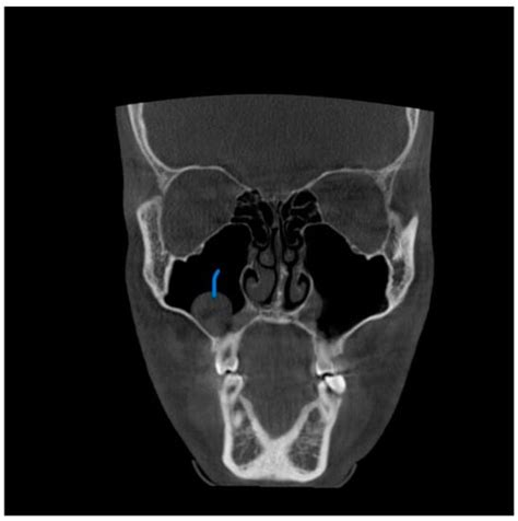 Diagnostics Free Full Text Prevalence Of Incidental Maxillary Sinus Anomalies On Cbct Scans