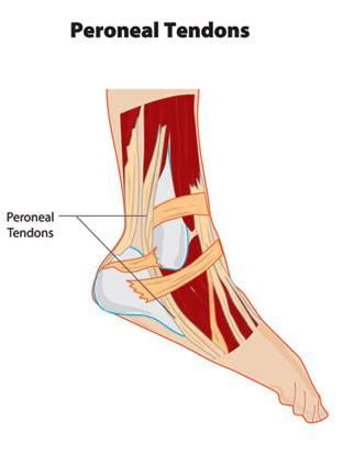 Peroneal Tendon Subluxation Exercises Exercise