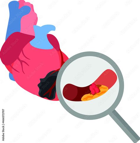 Illustration Depicting Myocardial Infarction As A Result Of The