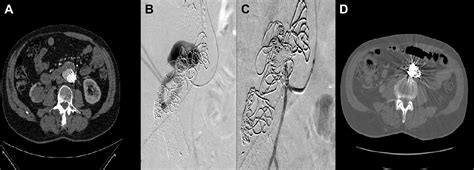 Pre Emptive Nonselective Perigraft Aortic Sac Embolization With Coils