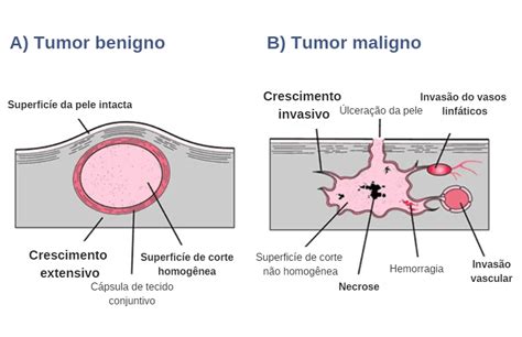 O Que Um Tumor Benigno Educar Sa De