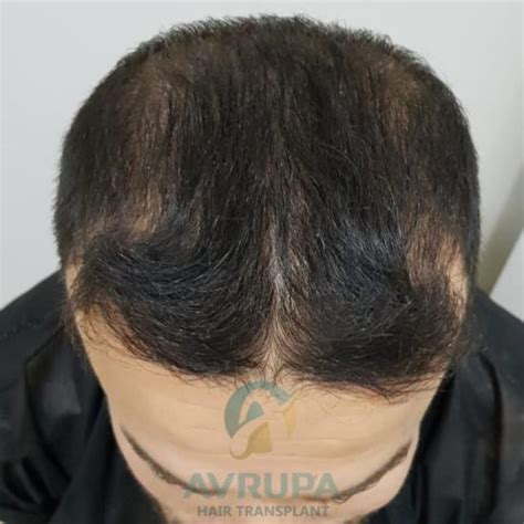 Dense Packing Hair Transplant In Turkey With 3200 Grafts Hair