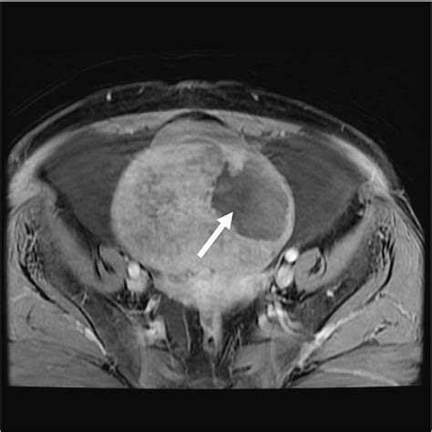 Axial T Weighted Post Contrast Mri Image Showing Solid Component