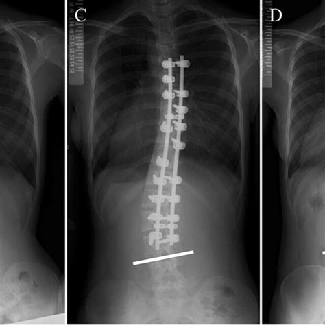 A 16 Year Old Girl With Lenke 5c Adolescent Idiopathic Scoliosis Ais Download Scientific