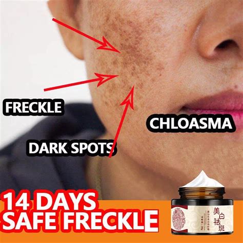 Whitening Freckle Dark Spot Remover Melasma Removal Cream Original Say