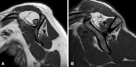 classifications   goutallier classification  fatty