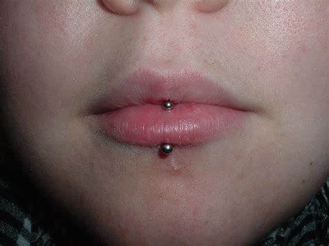 Vertical Labret Scar