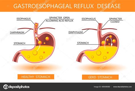 Gastroesophageal Reflux Disease 3d Acid Reflux Heartburn And Gerd Infographic With Medical