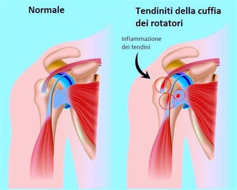 Tendinite Del Sovraspinoso Della Spalla Sintomi Ed Esercizi