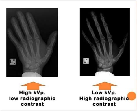 Chapter 11 Radiographic Exposure Technique Flashcards Quizlet