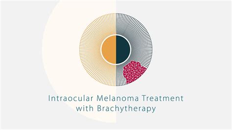 Intraocular Melanoma Treatment With Brachytherapy Youtube