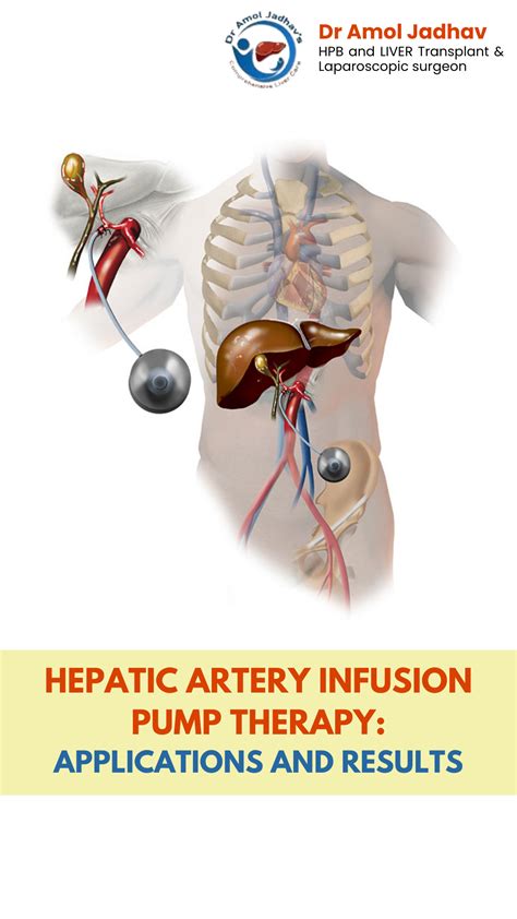 Hepatic Artery Infusion Pump Therapy Dr Amol Jadhav Best Liver