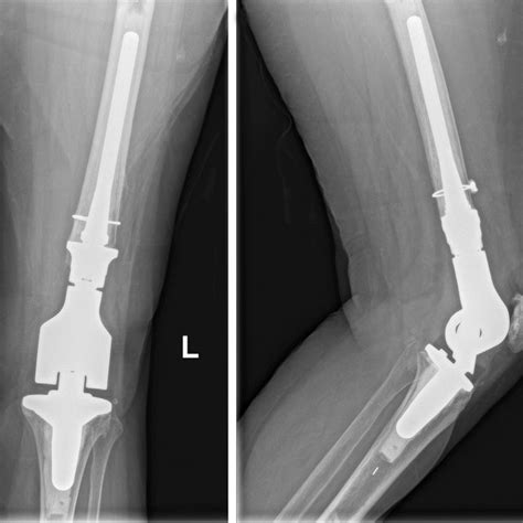 Anteroposterior And Lateral Radiograph Of The Left Knee At Year