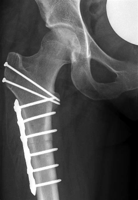 Best Practices Hip Femoroacetabular Impingement Ajr