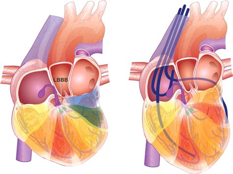 Cardiac Resynchronization Therapy