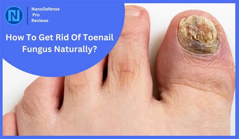 How To Get Rid Of Toenail Fungus Naturally 8 Home Remedies