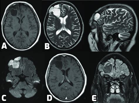 A T1 Weighted Axial Magnetic Resonance Imaging Mri Of The Brain