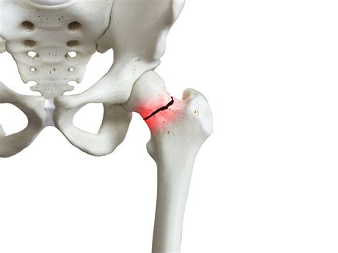 Fractura de cadera causas síntomas y tratamiento Salud IDEAL