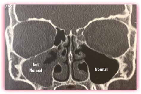 Several Sinus Surgery Types That Make a BIG impact - Dr Momma Says